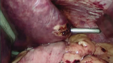 Laparoscopic, Gastrectomy, operation, endoscope Video stock 236361700