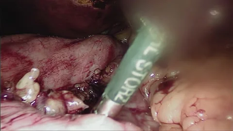 Laparoscopic, Gastrectomy, operation, endoscope Video stock 236361799