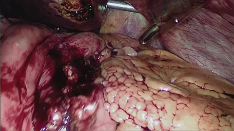 Laparoscopic, Gastrectomy, operation, endoscope Video stock 236361880