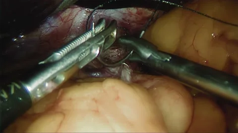 Laparoscopic, Gastrectomy, operation, endoscope Video stock 236362366