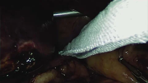 Laparoscopic, Gastrectomy, operation, endoscope Video stock 236364699