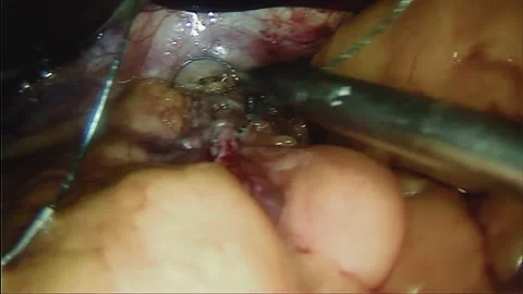 Laparoscopic, Gastrectomy, operation, endoscope Video stock 236364778