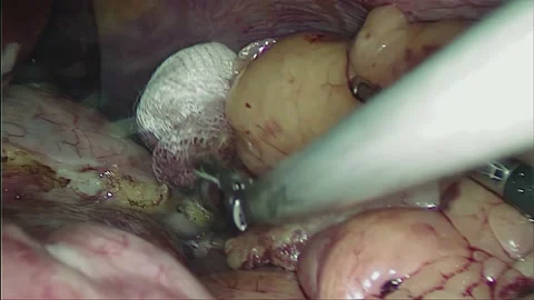 Laparoscopic, Gastrectomy, operation, endoscope Video stock 236364994