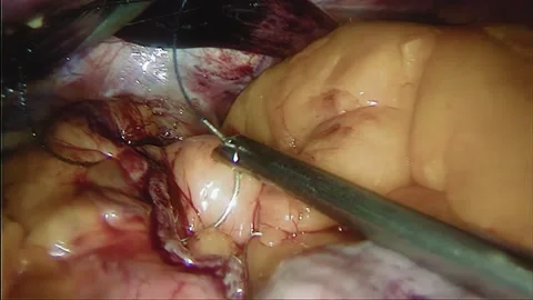 Laparoscopic, Gastrectomy, operation, endoscope Video stock 236365163