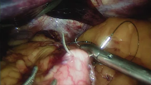 Laparoscopic, Gastrectomy, operation, endoscope Video stock 236367984