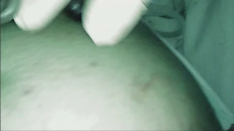 Laparoscopic, Gastrectomy, operation, endoscope Video stock 236368330