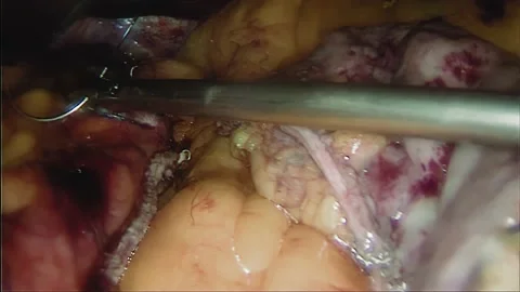 Laparoscopic, Gastrectomy, operation, endoscope Video stock 236368394
