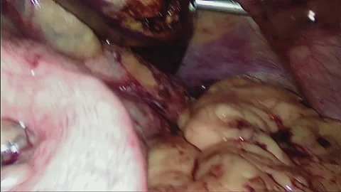 Laparoscopic, Gastrectomy, operation, endoscope Video stock 236368869