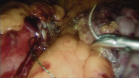Laparoscopic, Gastrectomy, operation, endoscope Video stock 236369288