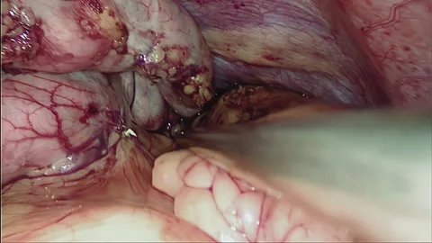 Laparoscopic, Gastrectomy, operation, endoscope Video stock 236370554