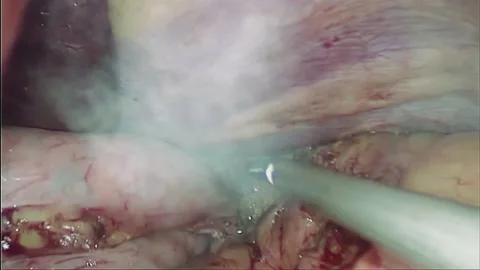 Laparoscopic, Gastrectomy, operation, endoscope Video stock 236370627