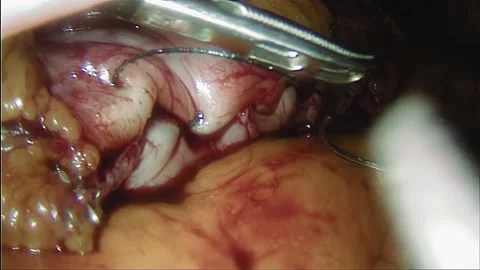 Laparoscopic, Gastrectomy, operation, endoscope Video stock 236370651