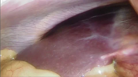Laparoscopic, Gastrectomy, operation, endoscope Video stock 236371432