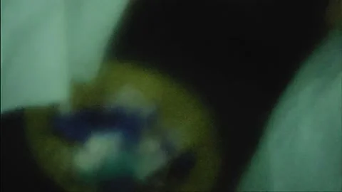 Laparoscopic, Gastrectomy, operation, endoscope Video stock 236371526