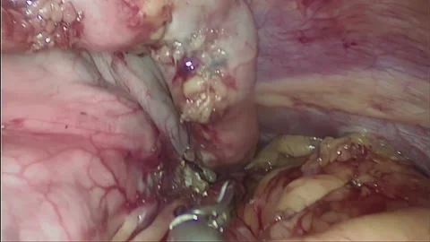 Laparoscopic, Gastrectomy, operation, endoscope Video stock 236371527
