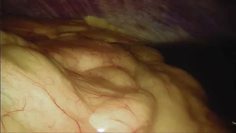 Laparoscopic, Gastrectomy, operation, endoscope Video stock 236371558