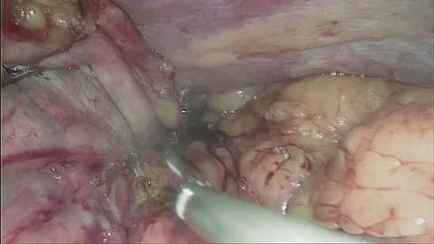 Laparoscopic, Gastrectomy, operation, endoscope Video stock 236371580