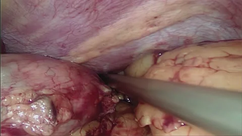 Laparoscopic, Gastrectomy, operation, endoscope Video stock 236372107