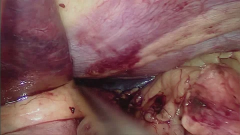 Laparoscopic, Gastrectomy, operation, endoscope Video stock 236372115