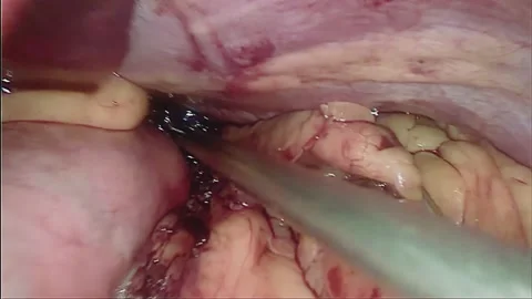 Laparoscopic, Gastrectomy, operation, endoscope Video stock 236372119