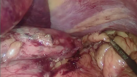 Laparoscopic, Gastrectomy, operation, endoscope Video stock 236372120
