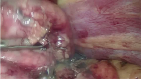 Laparoscopic, Gastrectomy, operation, endoscope Video stock 236372235