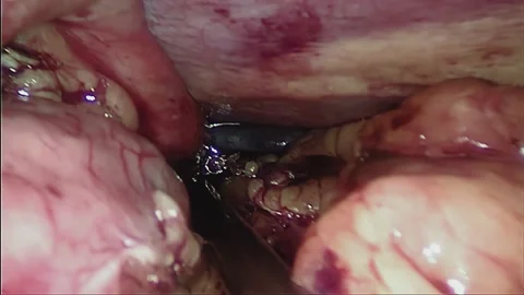 Laparoscopic, Gastrectomy, operation, endoscope Video stock 236372827