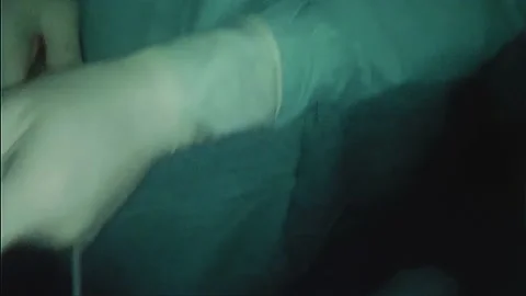 Laparoscopic, Gastrectomy, operation, endoscope Video stock 236372856