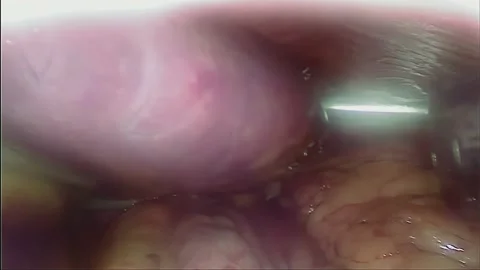 Laparoscopic, Gastrectomy, operation, endoscope Video stock 236372888