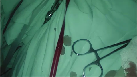 Laparoscopic, Gastrectomy, operation, endoscope Stock Footage 236372918