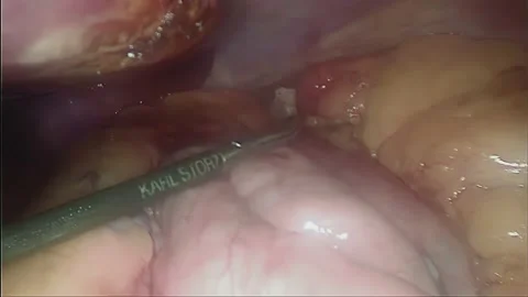 Laparoscopic, Gastrectomy, operation, endoscope Video stock 236372976