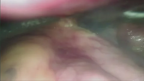 Laparoscopic, Gastrectomy, operation, endoscope Stock Footage 236373534