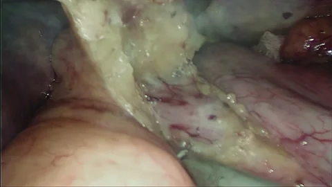 Laparoscopic, Gastrectomy, operation, endoscope Stock Footage 236373540