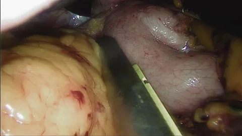 Laparoscopic, Gastrectomy, operation, endoscope Stock Footage 236374219