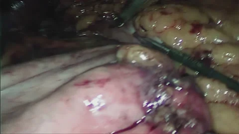 Laparoscopic, Gastrectomy, operation, endoscope Stock Footage 236374527