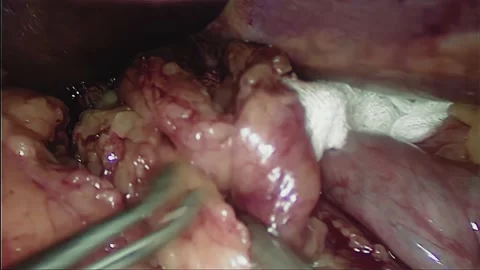 Laparoscopic, Gastrectomy, operation, endoscope Stock Footage 236374733