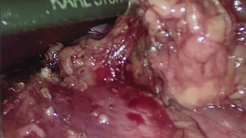 Laparoscopic, Gastrectomy, operation, endoscope Stock Footage 236374756