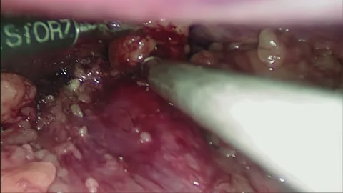 Laparoscopic, Gastrectomy, operation, endoscope Stock Footage 236374816