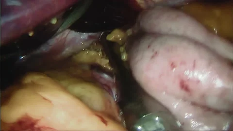 Laparoscopic, Gastrectomy, operation, endoscope Stock Footage 236375024