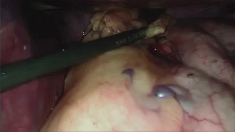 Laparoscopic, Gastrectomy, operation, endoscope Stock Footage 236375099