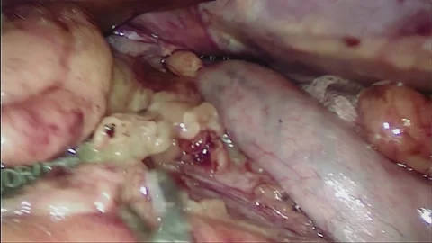 Laparoscopic, Gastrectomy, operation, endoscope Stock Footage 236375230