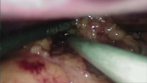 Laparoscopic, Gastrectomy, operation, endoscope Stock Footage 236375392