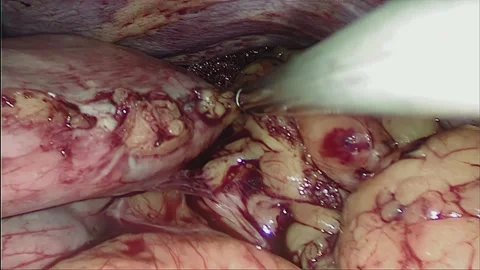 Laparoscopic, Gastrectomy, operation, endoscope Stock Footage 236375395