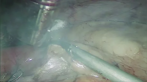 Laparoscopic, Gastrectomy, operation, endoscope Stock Footage 236375429