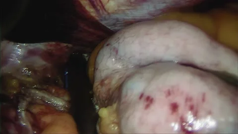 Laparoscopic, Gastrectomy, operation, endoscope Stock Footage 236375432