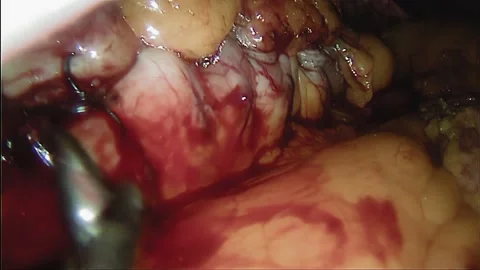 Laparoscopic, Gastrectomy, operation, endoscope Stock Footage 236375478