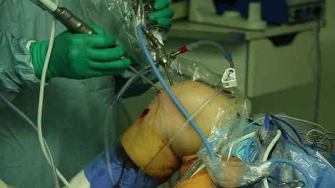 Laparoscopic operation Stock Footage 82059766