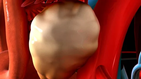 Laparoscopic ovarian drilling Stock Footage 63527003