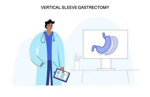 Laparoscopic sleeve gastrectomy Stock Illustration