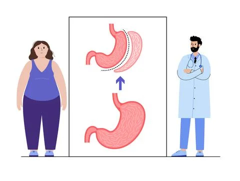 Laparoscopic sleeve gastrectomy Stock Illustration